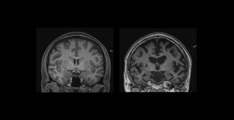 Brain MRI